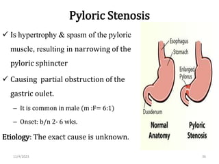 Pyloric Stenosis
 Is hypertrophy & spasm of the pyloric
muscle, resulting in narrowing of the
pyloric sphincter
 Causing partial obstruction of the
gastric oulet.
– It is common in male (m :F= 6:1)
– Onset: b/n 2- 6 wks.
Etiology: The exact cause is unknown.
11/4/2023 36
 