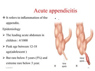 Acute appendicitis
 It refers to inflammation of the
appendix.
Epidemiology
 The leading acute abdomen in
children : 4/1000
 Peak age between 12-18
age(adolescent )
 But rare below 5 years (5%) and
extreme rare below 3 year.
• .
11/4/2023 40
 