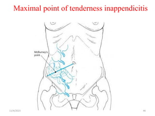 Maximal point of tenderness inappendicitis
11/4/2023 46
 