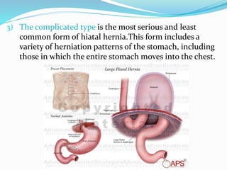 3) The complicated type is the most serious and least
common form of hiatal hernia.This form includes a
variety of herniation patterns of the stomach, including
those in which the entire stomach moves into the chest.
 
