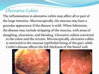 Ulcerative Colitis
The inflammation in ulcerative colitis may affect all or part of
the large intestine. Macroscopically, the mucosa may have a
granular appearance if the disease is mild. When fulminant,
the disease may include stripping of the mucosa, with areas of
sloughing, ulceration, and bleeding .Ulcerative colitisi restricted
to the colon and the rectum. Microscopically, ulcerative colitis
is restricted to the mucosa (epithelial lining of the gut), while
Crohn's disease affects the full thickness of the bowel wall.
 