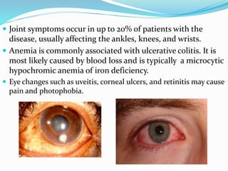  Joint symptoms occur in up to 20% of patients with the
disease, usually affecting the ankles, knees, and wrists.
 Anemia is commonly associated with ulcerative colitis. It is
most likely caused by blood loss and is typically a microcytic
hypochromic anemia of iron deficiency.
 Eye changes such as uveitis, corneal ulcers, and retinitis may cause
pain and photophobia.
 