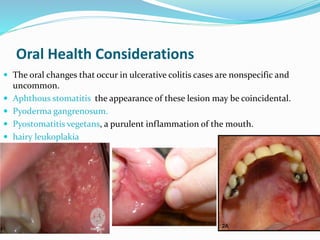 Oral Health Considerations
 The oral changes that occur in ulcerative colitis cases are nonspecific and
uncommon.
 Aphthous stomatitis the appearance of these lesion may be coincidental.
 Pyoderma gangrenosum.
 Pyostomatitis vegetans, a purulent inflammation of the mouth.
 hairy leukoplakia
 
