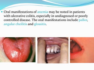  Oral manifestations of anemia may be noted in patients
with ulcerative colitis, especially in undiagnosed or poorly
controlled disease. The oral manifestations include pallor,
angular cheilitis and glossitis.
 