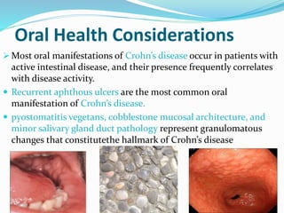 Oral Health Considerations
 Most oral manifestations of Crohn’s disease occur in patients with
active intestinal disease, and their presence frequently correlates
with disease activity.
 Recurrent aphthous ulcers are the most common oral
manifestation of Crohn’s disease.
 pyostomatitis vegetans, cobblestone mucosal architecture, and
minor salivary gland duct pathology represent granulomatous
changes that constitutethe hallmark of Crohn’s disease
 