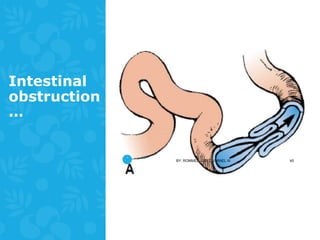 NURSING MANAGEMENT-GASTROINTESTINAL TRACT DYSFUNCTION | PPTX