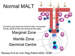 Marginal Zone
Mantle Zone
Germinal Centre
(Contains post germinal centre B cells, monocytoid
B cells, plasma cells and centrocyte like cells)
Normal MALT
Rooney N et al: Curr Diag Pathol 2004; 10:69
 