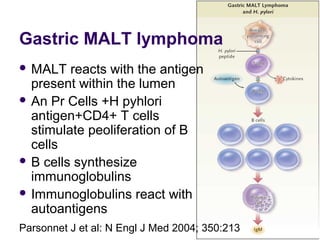 Gastric MALT lymphoma
 MALT reacts with the antigen
present within the lumen
 An Pr Cells +H pyhlori
antigen+CD4+ T cells
stimulate peoliferation of B
cells
 B cells synthesize
immunoglobulins
 Immunoglobulins react with
autoantigens
Parsonnet J et al: N Engl J Med 2004; 350:213
 