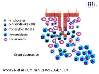 Rooney N et al: Curr Diag Pathol 2004; 10:69
 