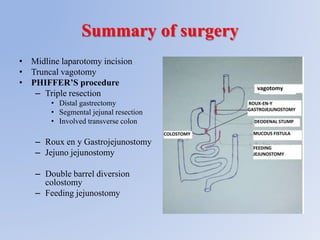Summy Incision Gastrojejunocoilic fistula | PPTX