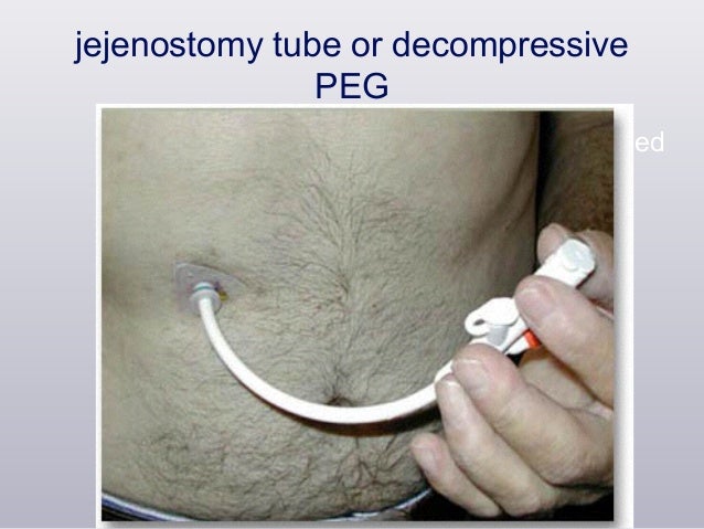 Gastroparesis CSGNA 2016 Gastroparesis CSGNA 2016
