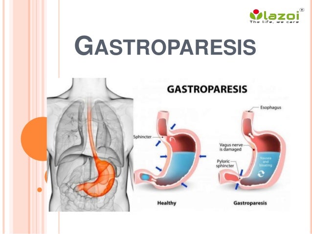 gastroparesis symptoms and causes gastroparesis symptoms and causes
