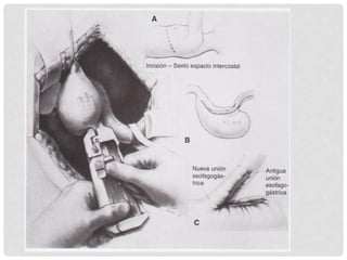 Gastroplastia de collis | PDF