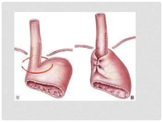 Gastroplastia de collis | PDF