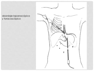 Gastroplastia de collis | PDF