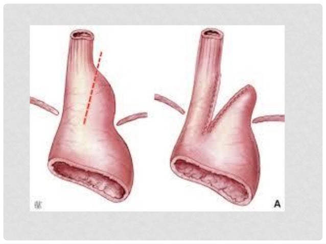 Collis-Gastroplastik , Reflux-Behandlung – EQRM