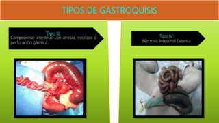 Tipo III:
Compromiso intestinal con atresia, necrosis o
perforación gástrica.
Tipo IV:
Necrosis Intestinal Extensa
 