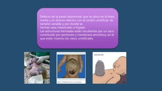 Defecto de la pared abdominal, que se ubica en la línea
media y en directa relación con el cordón umbilical, de
tamaño variable y por donde se
hernian asas intestinales e hígado.
Las estructuras herniadas están recubiertas por un saco
constituido por peritoneo y membrana amniótica, en el
que están insertos los vasos umbilicales.
 