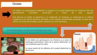 Los bebés con gastrosquisis presentan un agujero en la pared abdominal. los intestinos del niño
generalmente sobresalen (protruyen) a través de este agujero.
Esta afección es similar en apariencia a un onfalocele. sin embargo, un onfalocele es un defecto
congénito en el cual los intestinos del bebé u otros órganos abdominales sobresalen a través de un
orificio en el área del ombligo y están cubiertos con una membrana.
En los bebés con gastrosquisis, los intestinos (y a veces el
estómago) permanecen fuera de la pared abdominal, sin
una membrana que los cubra.
La causa exacta de los defectos de la pared abdominal se
desconoce
En la Gastrosquisis, no hay una membrana que cubra.
 