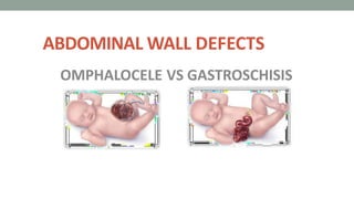 ABDOMINAL WALL DEFECTS
OMPHALOCELE VS GASTROSCHISIS
 