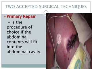 TWO ACCEPTED SURGICAL TECHNIQUES

 Primary Repair
  - is the
 procedure of
 choice if the
 abdominal
 contents will fit
 into the
 abdominal cavity.
 