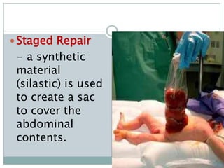  Staged Repair
 - a synthetic
 material
 (silastic) is used
 to create a sac
 to cover the
 abdominal
 contents.
 