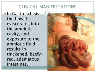 CLINICAL MANIFESTATIONS
 In Gastroschisis
 the bowel
 eviscerates into
 the amniotic
 cavity, and
 exposure to the
 amniotic fluid
 results in
 thickened, beefy-
 red, edematous
 intestines.
 