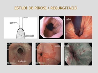 ESTUDI DE PIROSI / REGURGITACIÓ Esofagitis Esófag de Barrett Hernia de hiatus 