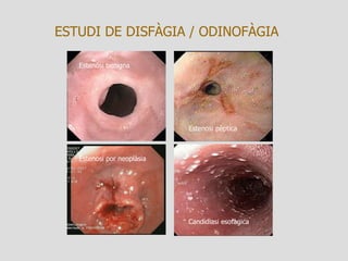 ESTUDI DE DISFÀGIA / ODINOFÀGIA Estenosi benigna Estenosi pèptica Estenosi por neoplàsia Candidiasi esofàgica 
