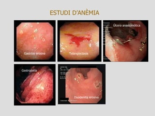 ESTUDI D’ANÈMIA Gastritis erosiva Duodenitis erosiva Telangiectasia Úlcera anastomótica Gastropatía 