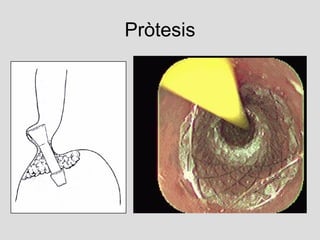 Pròtesis 