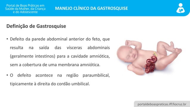 Manejo Clínico da Gastrosquise