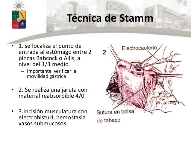 Gastrostomías y yeyunostomías