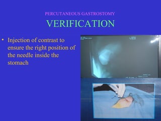 • Injection of contrast to
ensure the right position of
the needle inside the
stomach
PERCUTANEOUS GASTROSTOMY
VERIFICATION
 