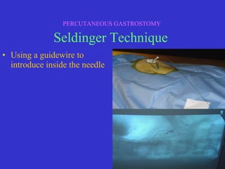 • Using a guidewire to
introduce inside the needle
PERCUTANEOUS GASTROSTOMY
Seldinger Technique
 