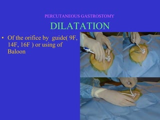 • Of the orifice by guide( 9F,
14F, 16F ) or using of
Baloon
PERCUTANEOUS GASTROSTOMY
DILATATION
 
