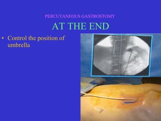 • Control the position of
umbrella
PERCUTANEOUS GASTROSTOMY
AT THE END
 