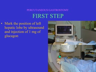 • Mark the position of left
hepatic lobe by ultrasound
and injection of 1 mg of
glucagon
PERCUTANEOUS GASTROSTOMY
FIRST STEP
 