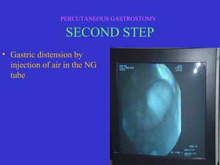 • Gastric distension by
injection of air in the NG
tube
PERCUTANEOUS GASTROSTOMY
SECOND STEP
 
