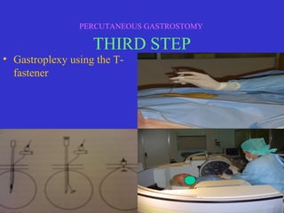 PERCUTANEOUS GASTROSTOMY
THIRD STEP
• Gastroplexy using the T-
fastener
 