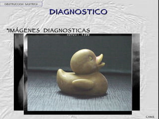 DIAGNOSTICO IMÁGENES  DIAGNOSTICAS OBSTRUCCION  GASTRICA CAMZ 
