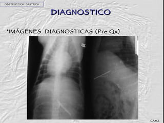 DIAGNOSTICO IMÁGENES  DIAGNOSTICAS (Pre Qx) OBSTRUCCION  GASTRICA CAMZ 