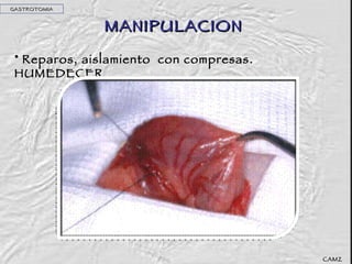 MANIPULACION Reparos, aislamiento  con compresas. HUMEDECER GASTROTOMIA CAMZ 