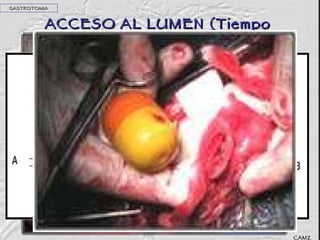ACCESO AL LUMEN (Tiempo séptico) GASTROTOMIA CAMZ 
