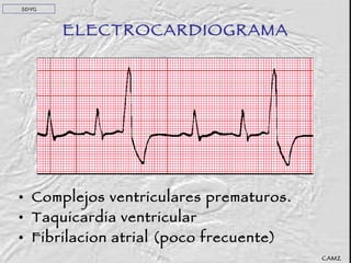 ELECTROCARDIOGRAMA Complejos ventriculares prematuros. Taquicardia ventricular Fibrilacion atrial (poco frecuente) CAMZ SDVG 