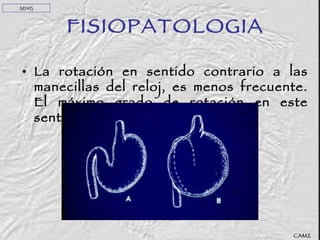 La rotación en sentido contrario a las manecillas del reloj, es menos frecuente. El máximo grado de rotación en este sentido es de 90 grados.  FISIOPATOLOGIA CAMZ SDVG 