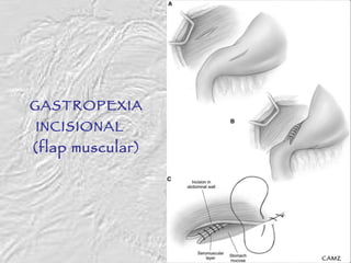 GASTROPEXIA INCISIONAL  (flap muscular) CAMZ 