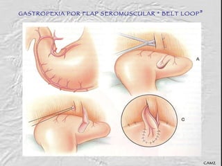 GASTROPEXIA POR FLAP SEROMUSCULAR “ BELT LOOP ” CAMZ 