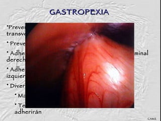 GASTROPEXIA Prevenir movimientos anormales en el eje transverso del abdomen, recurrentes. Preventivo Adhesion del Antro Pilórico a la pared abdominal derecha Adhesion del Fundus a la pared abdominal izquierda Diversas técnicas Materiales no absorvibles Tecnica adherente… serosas nunca se adherirán CAMZ 