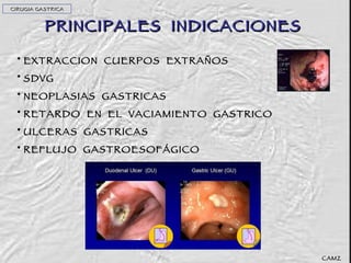 PRINCIPALES  INDICACIONES EXTRACCION  CUERPOS  EXTRAÑOS SDVG NEOPLASIAS  GASTRICAS RETARDO  EN  EL  VACIAMIENTO  GASTRICO ULCERAS  GASTRICAS REFLUJO  GASTROESOFÁGICO CAMZ CIRUGIA GASTRICA 